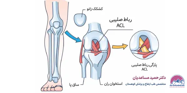 روش های تشخیص پارگی رباط صلیبی