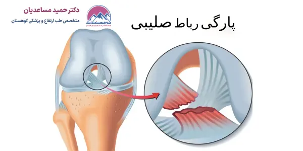 روش های تشخیص پارگی رباط صلیبی