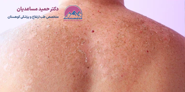 آفتاب سوختگی در کوهنوردی