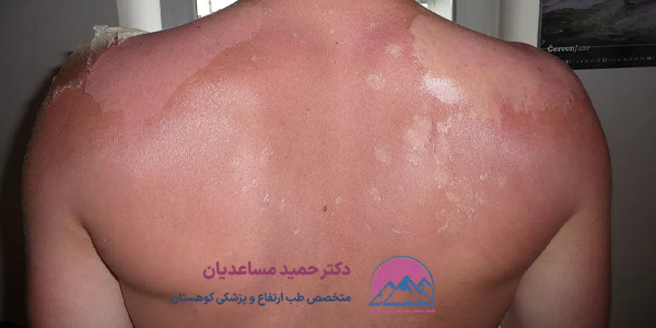 آفتاب سوختگی در کوهنوردی