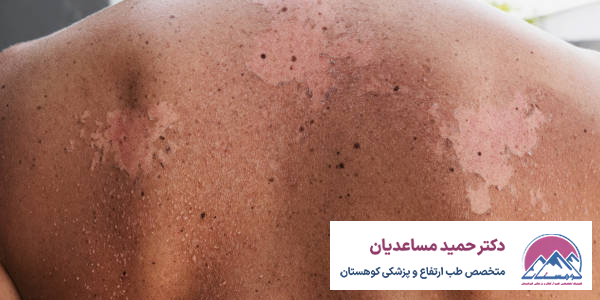 آفتاب سوختگی در کوهنوردی