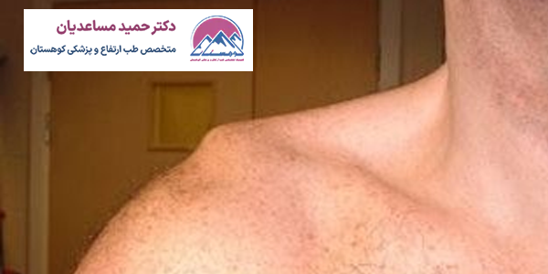 در رفتگی شانه