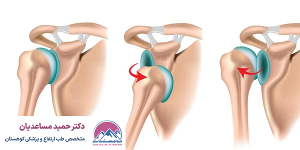 در رفتگی شانه
